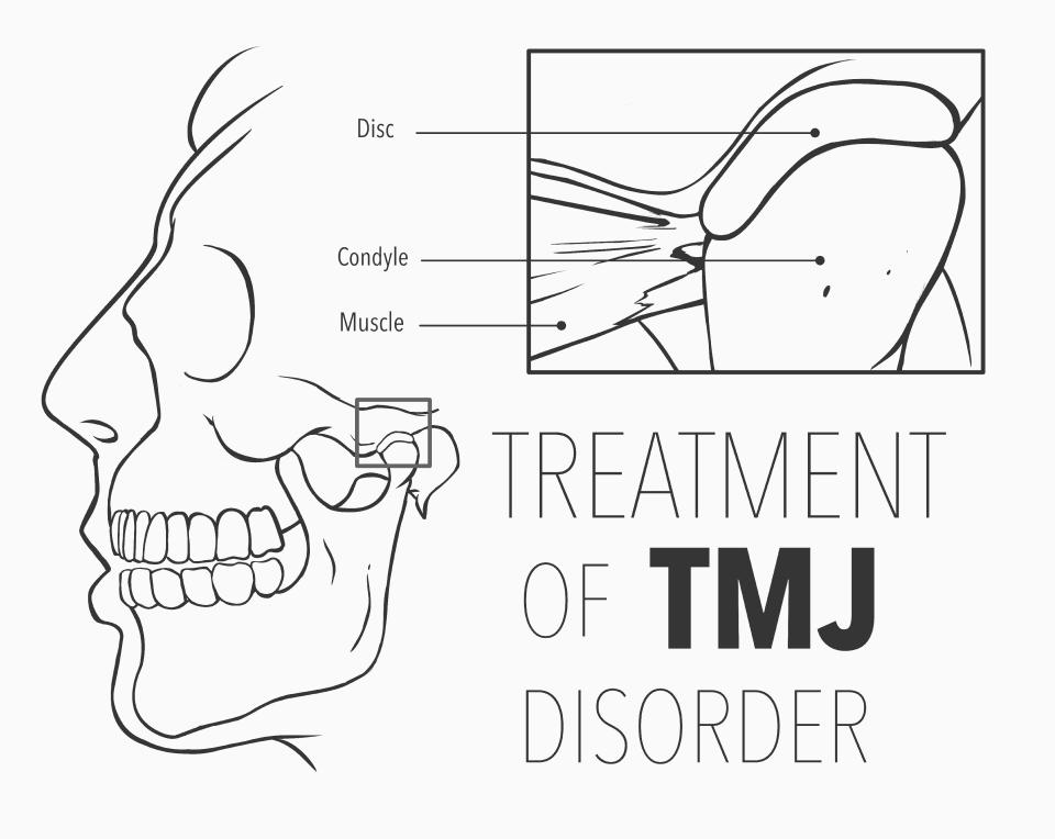 TMJ treatment diagram